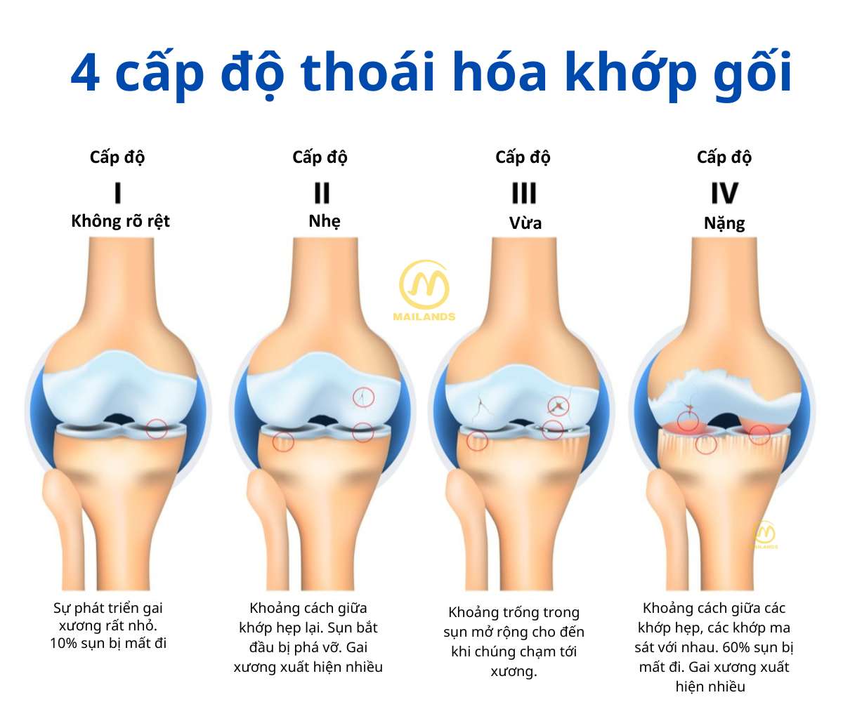 4 giai đoạn thoái hóa khớp gối