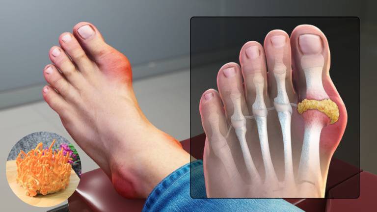 Đông trùng hạ thảo có hiệu quả trong điều trị bệnh gout?