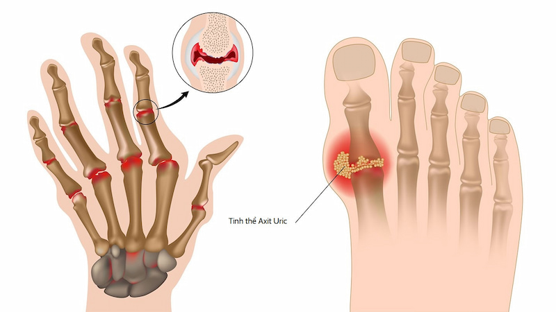 Các tinh thể nhỏ của axit uric tại khớp ra những cơn đau gút cấp