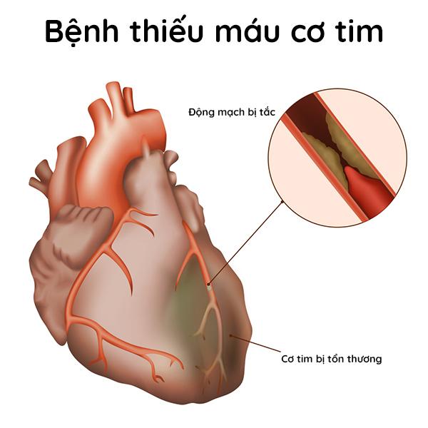 Bệnh thiếu máu cơ tim