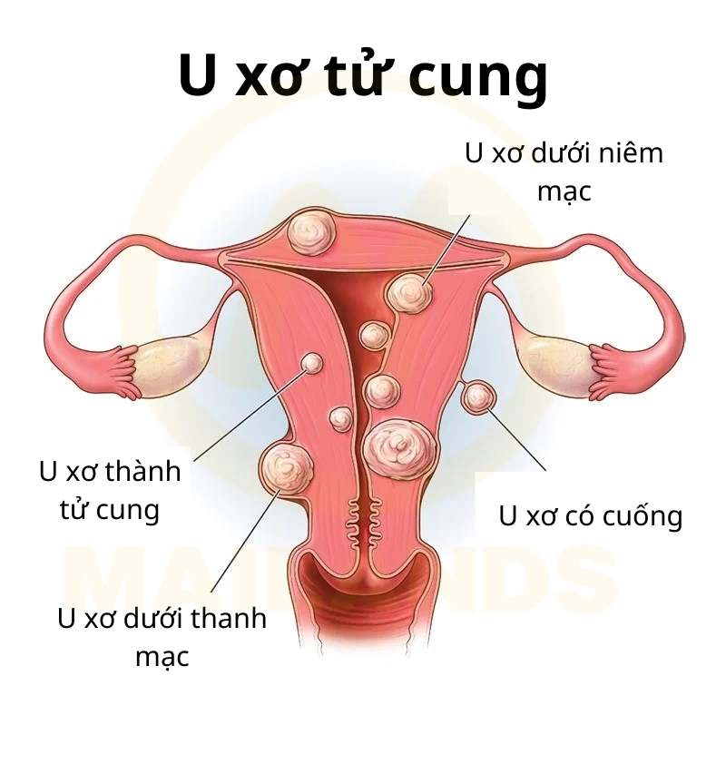 Các loại u xơ tử cung