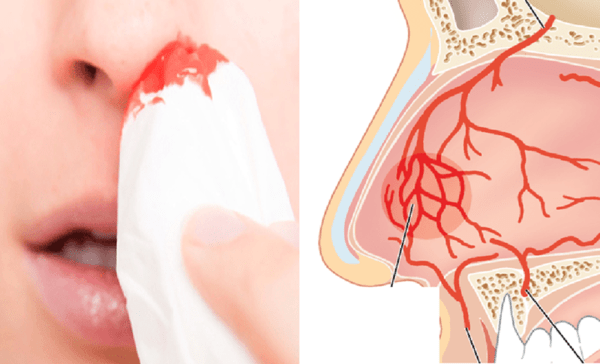 Tại sao khi dùng nhân sâm có thể chảy máu mũi và lưu ý