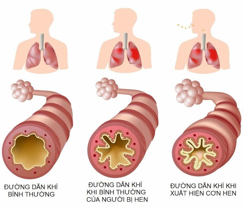 Hình ảnh đường hô hấp bị viêm do hen suyễn