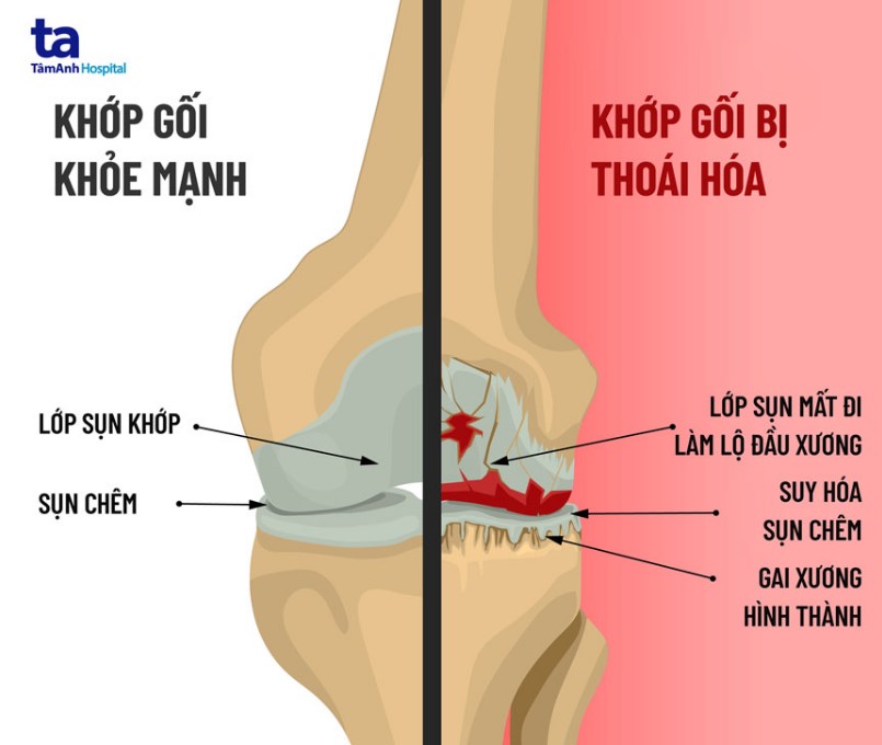 khớp gối bình thường và khớp gối thoái hóa