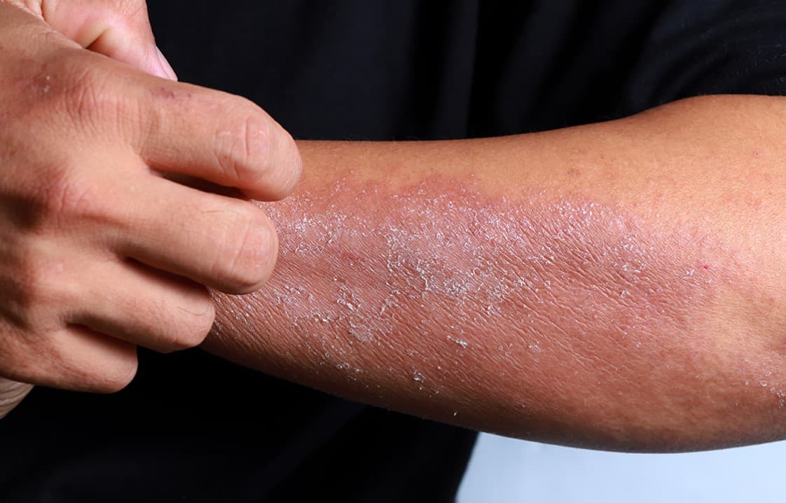 triệu chứng của bệnh Eczema